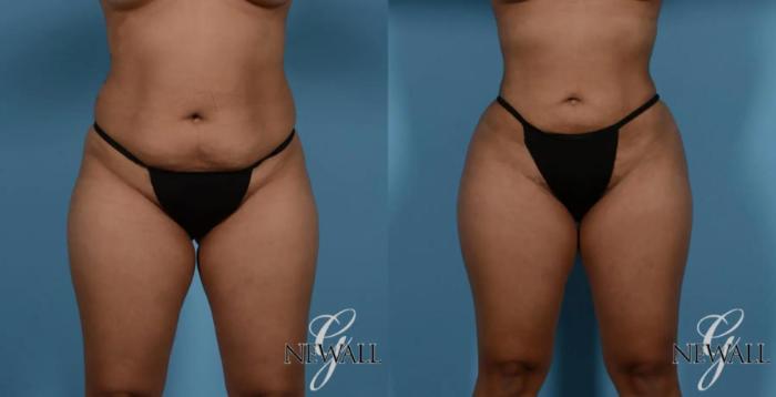 Before & After Liposuction Case 16983 View 1 View in Houston, TX