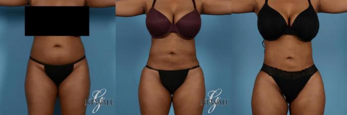 Before & After Liposuction Case 17019 View 1 View in Houston, TX