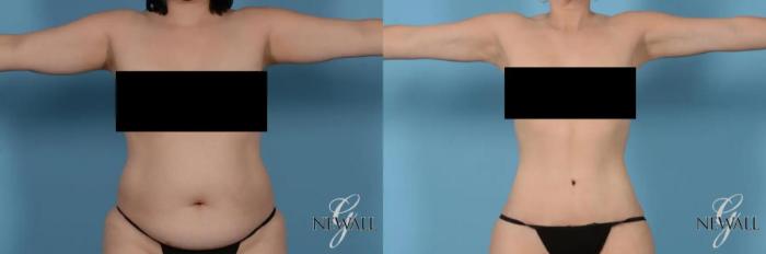 Before & After Liposuction Case 17442 View 1 View in Houston, TX