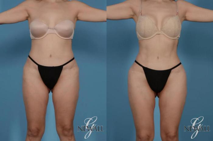 Before & After Liposuction Case 17519 View 1 View in Houston, TX