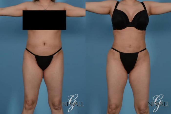 Before & After Liposuction Case 17524 View 1 View in Houston, TX