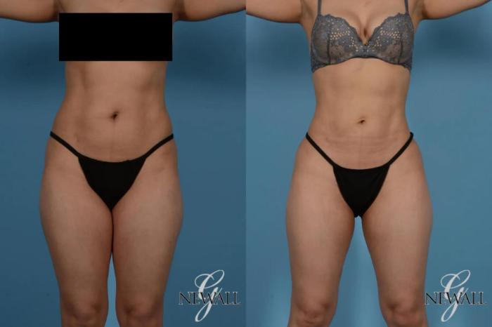 Before & After Liposuction Case 17535 View 1 View in Houston, TX