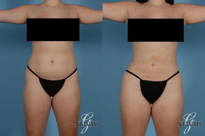Before & After Liposuction Case 17767 View 1 View in Houston, TX