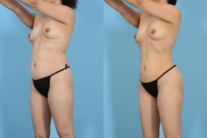 Before & After Brazilian Butt Lift Case 18129 Left Oblique View in Houston, TX