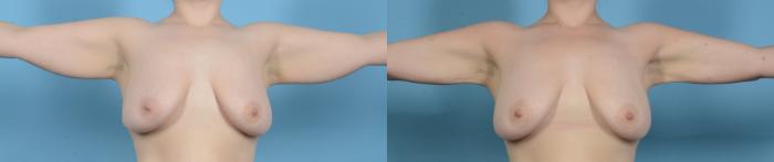 Before & After BodyTite Case 18155 Front 1 View in Houston, TX