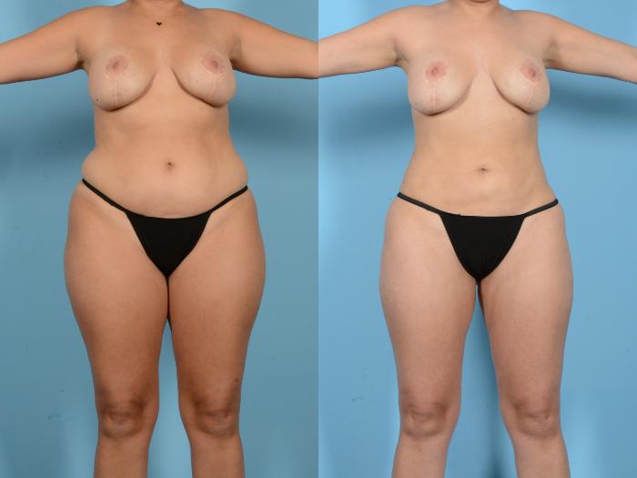 Before & After Liposuction Case 18163 Front 1 View in Houston, TX