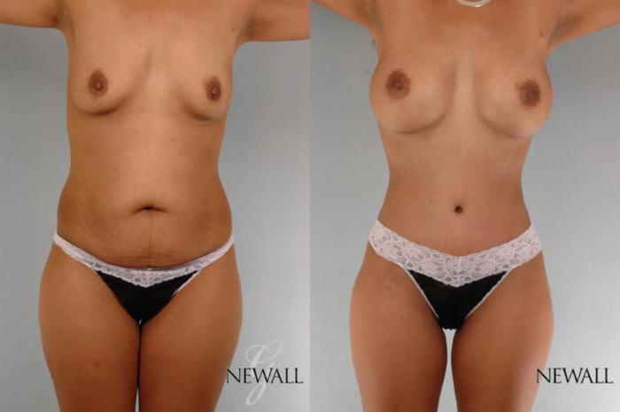 Before & After Tummy Tuck Case 17763 View 1 View in Houston, TX