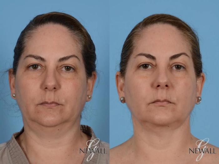 Before & After Neck Liposuction Case 17562 View 1 View in Houston, TX