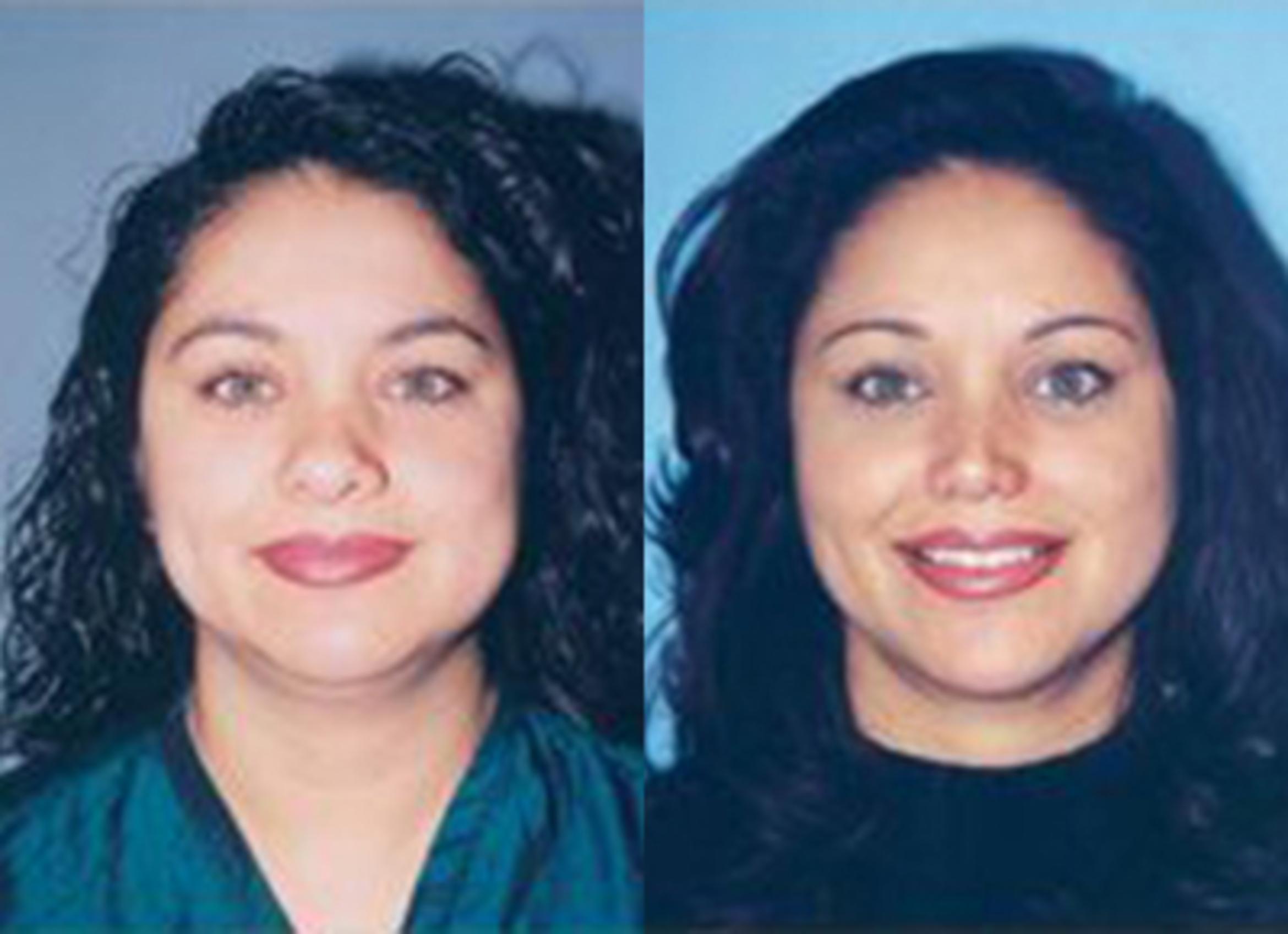 Before & After Neck Liposuction Case 5695 View 1 View in Houston, TX