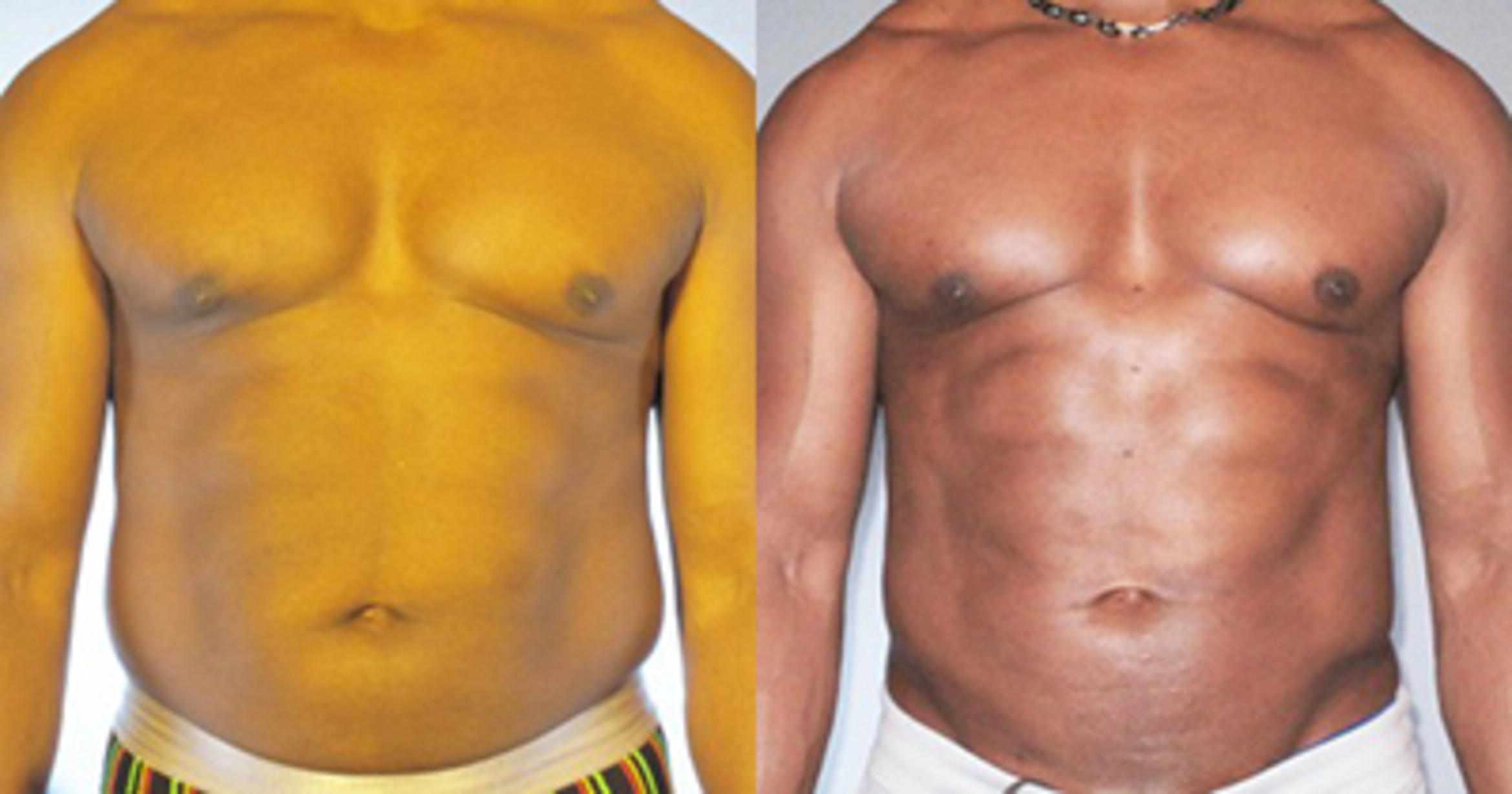 Before & After Neck Liposuction Case 91839999 View 1 View in Houston, TX