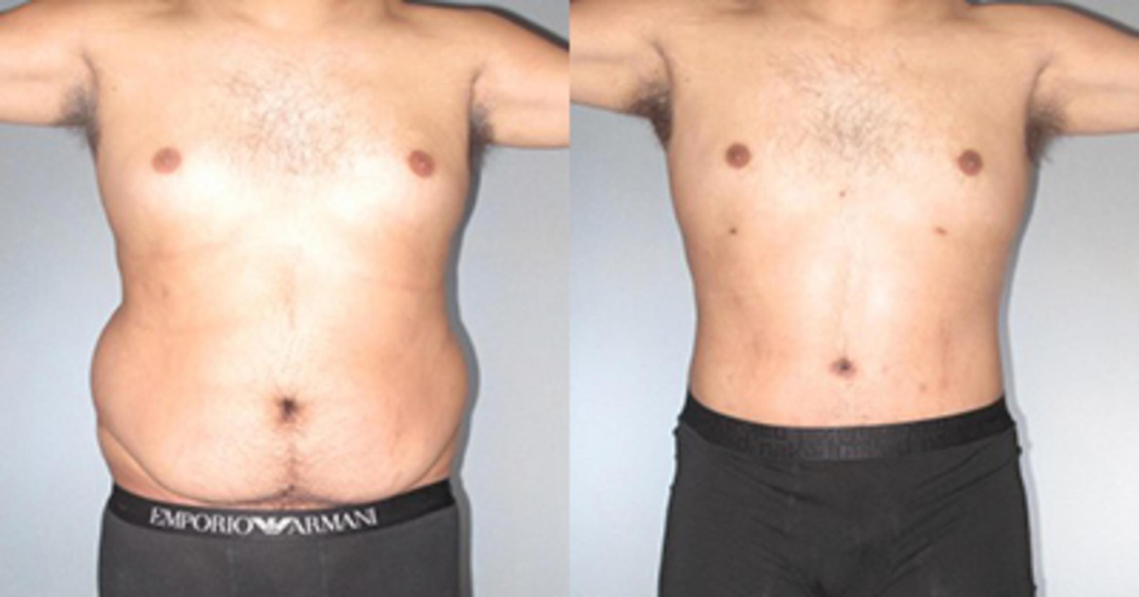 Before & After Neck Liposuction Case 92709999 View 1 View in Houston, TX