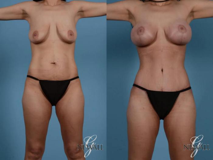 Before & After Tummy Tuck Case 16977 View 1 View in Houston, TX