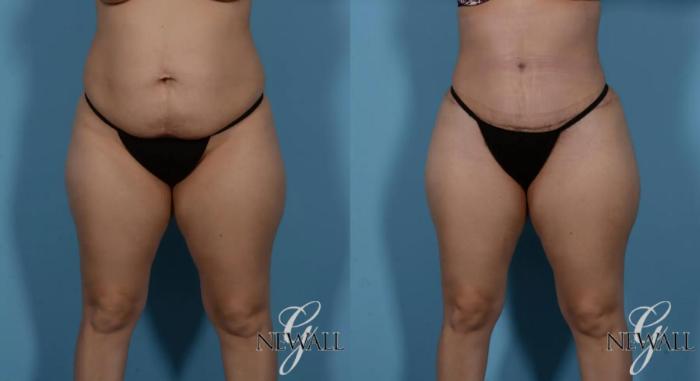 Before & After Tummy Tuck Case 16984 View 1 View in Houston, TX