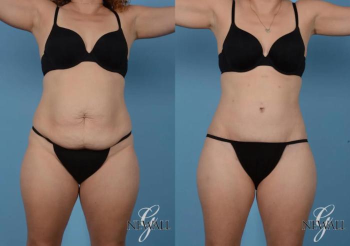 Before & After Tummy Tuck Case 16992 View 1 View in Houston, TX