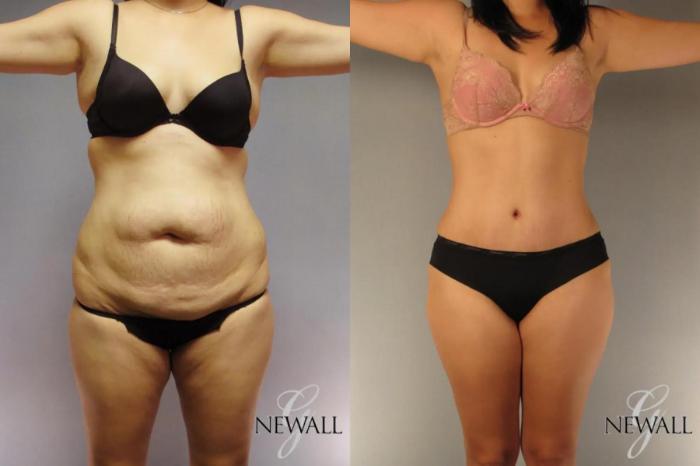 Before & After Tummy Tuck Case 17023 View 1 View in Houston, TX