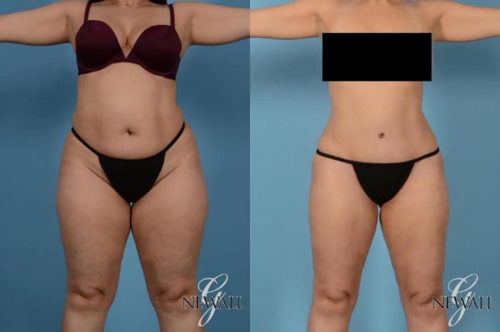 Before & After Tummy Tuck Case 17167 View 1 View in Houston, TX