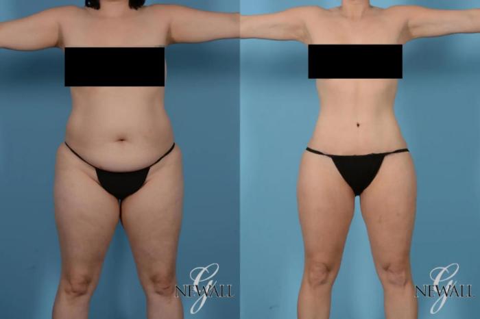 Before & After Tummy Tuck Case 17441 View 1 View in Houston, TX