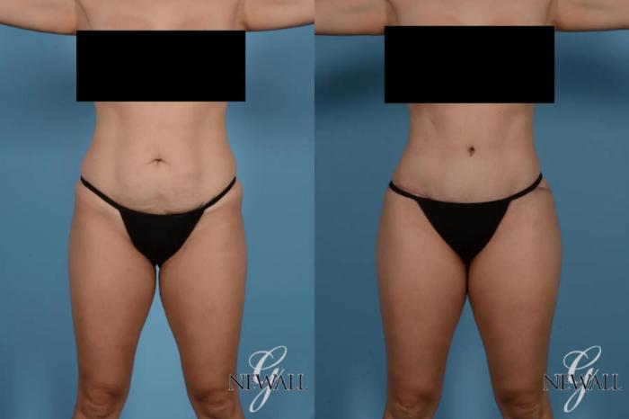 Before & After Tummy Tuck Case 17518 View 1 View in Houston, TX