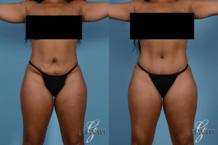 Before & After Tummy Tuck Case 17531 View 1 View in Houston, TX