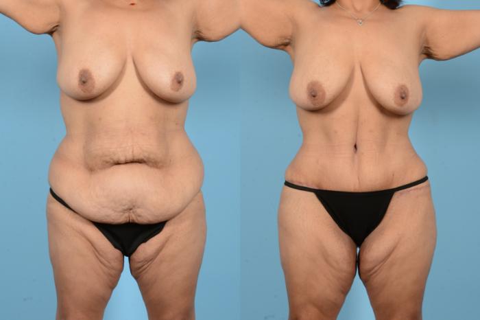Before & After Liposuction Case 18126 Front View in Houston, TX
