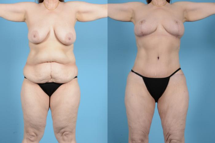 Before & After Brazilian Butt Lift Case 18132 Front View in Houston, TX