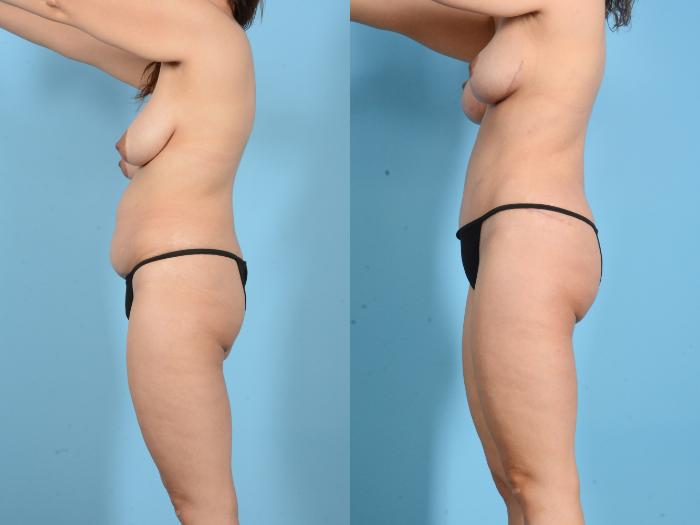 Before & After Brazilian Butt Lift Case 18134 Left Side View in Houston, TX