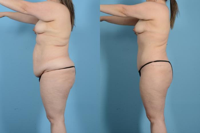 Before & After Tummy Tuck Case 18137 Left Side View in Houston, TX