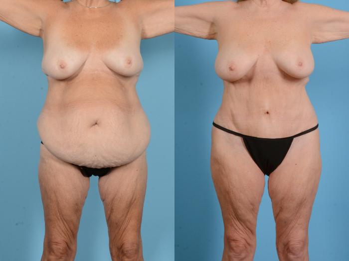Before & After Liposuction Case 18156 Front 1 View in Houston, TX