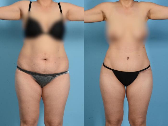 Before & After Liposuction Case 18164 Front 1 View in Houston, TX