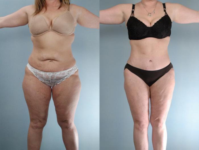 Before & After Tummy Tuck Case 613875210007 Front View in Houston, TX
