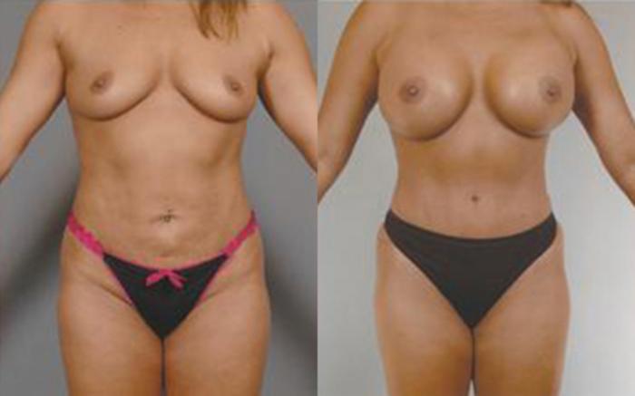 Before & After Tummy Tuck Case 70 View 1 View in Houston, TX
