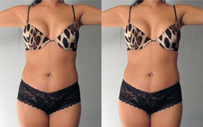 Before & After Tummy Tuck Case 74 View 1 View in Houston, TX