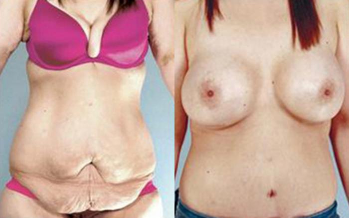 Before & After Tummy Tuck Case 79 View 1 View in Houston, TX