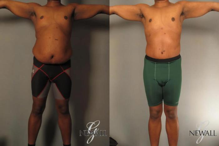 Before & After Tummy Tuck For Men Case 17812 View 1 View in Houston, TX