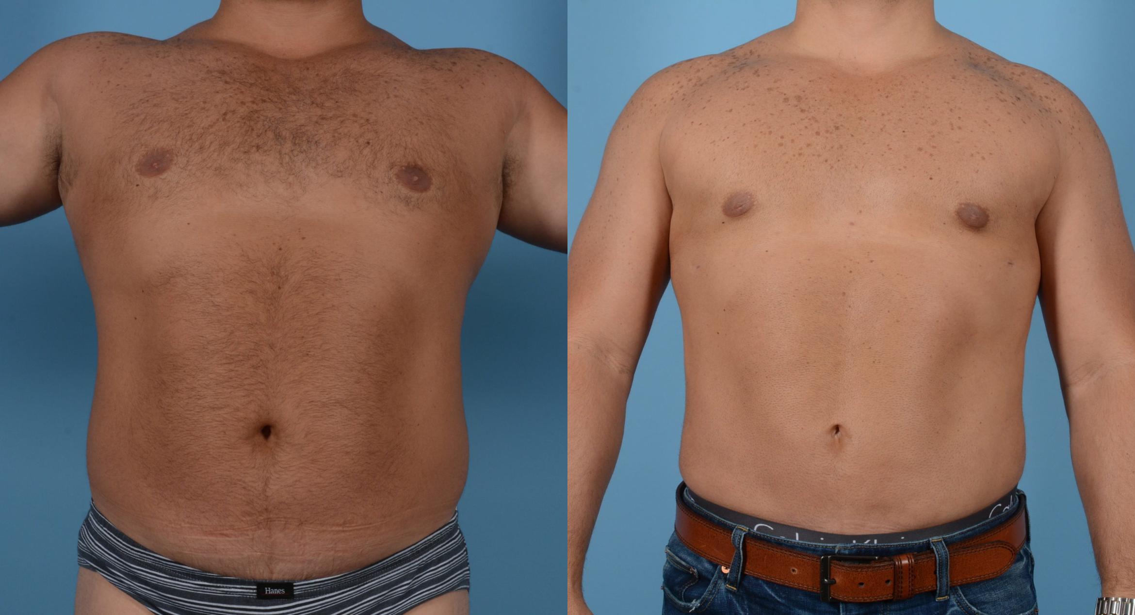 Before & After Abdominal Etching For Men Case 109394018 View 1 View in Houston, TX
