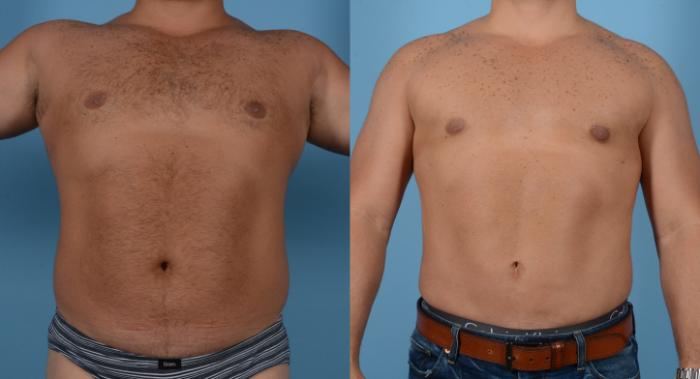 Before & After Abdominal Etching For Men Case 109394018 View 1 View in Houston, TX