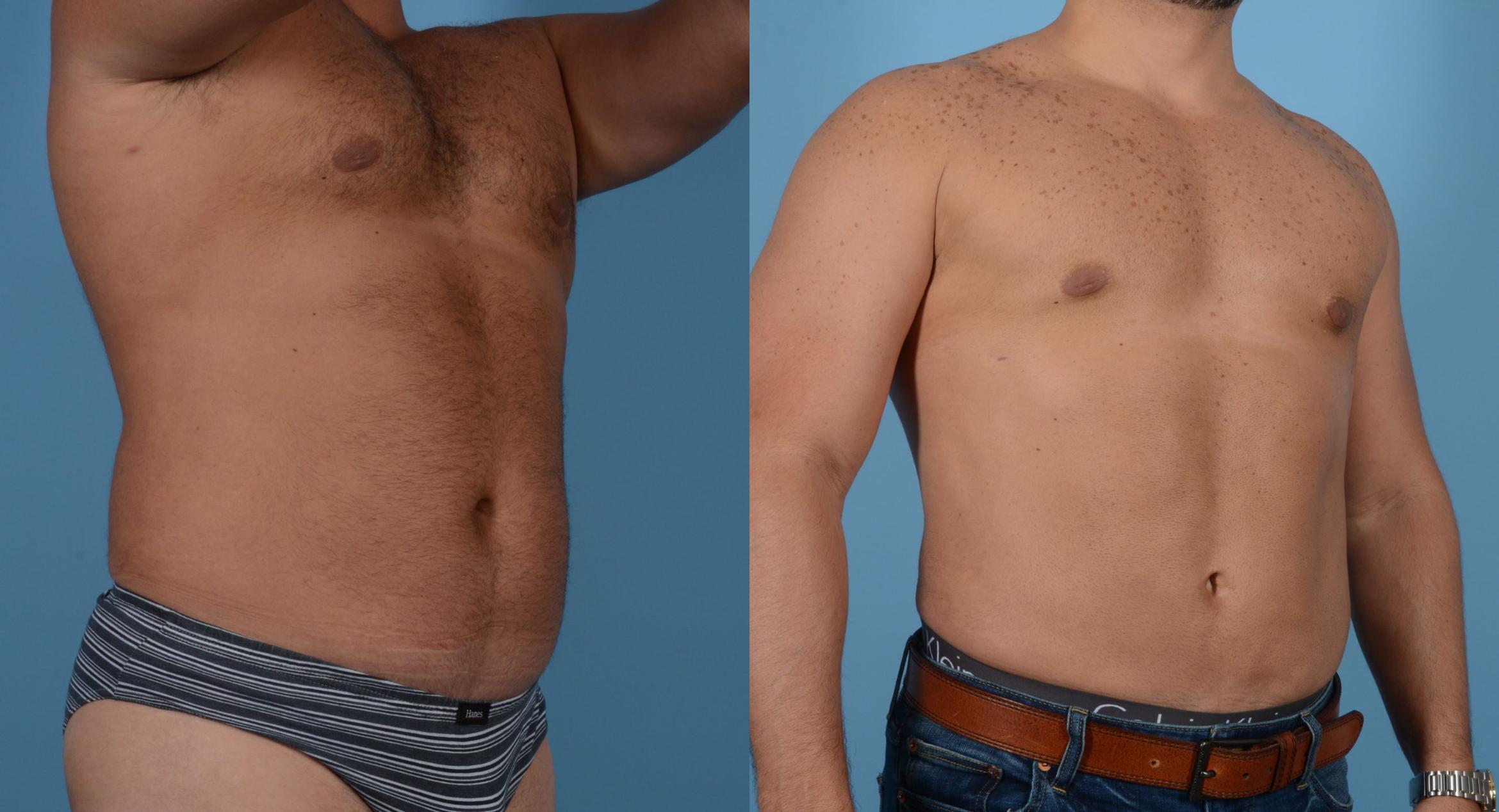 Before & After Abdominal Etching For Men Case 109394018 View 2 View in Houston, TX