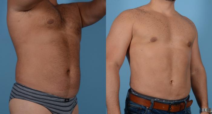 Before & After Abdominal Etching For Men Case 109394018 View 2 View in Houston, TX