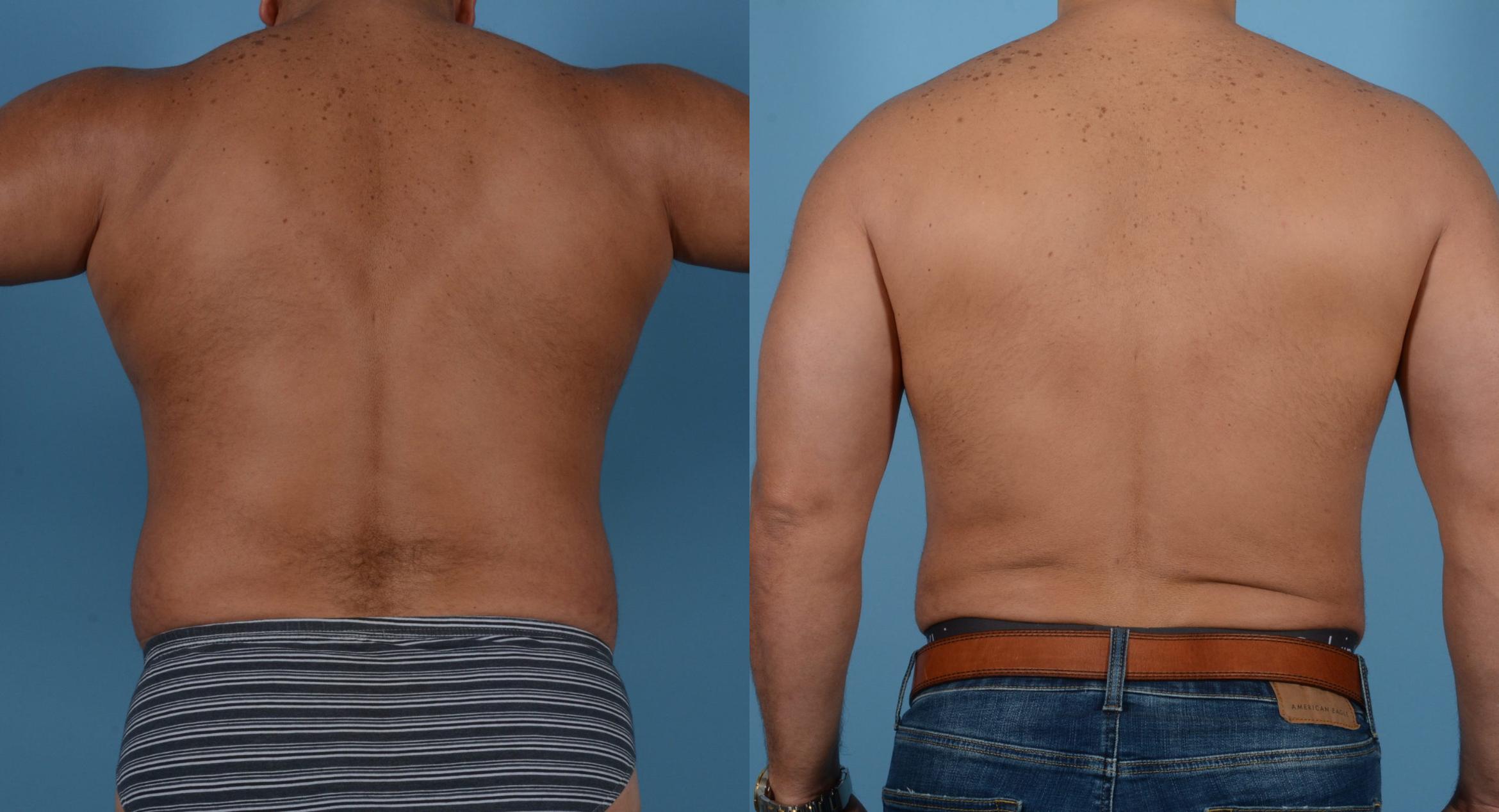 Before & After Abdominal Etching For Men Case 109394018 View 4 View in Houston, TX