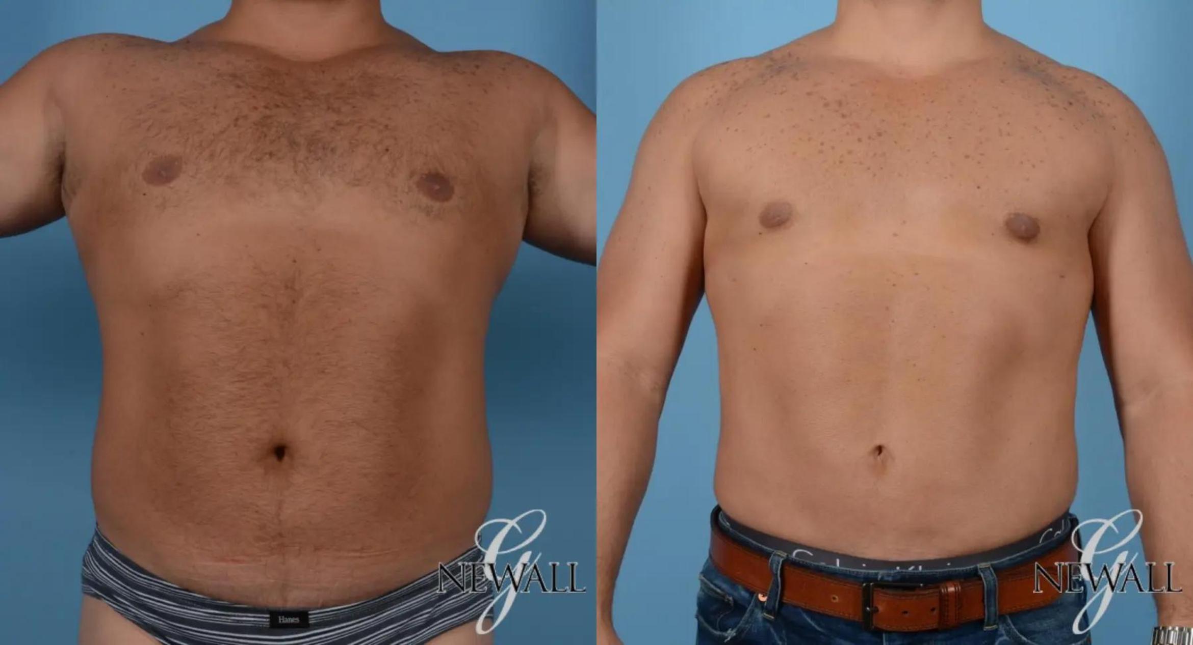 Before & After Abdominal Etching For Men Case 16978 View 1 View in Houston, TX