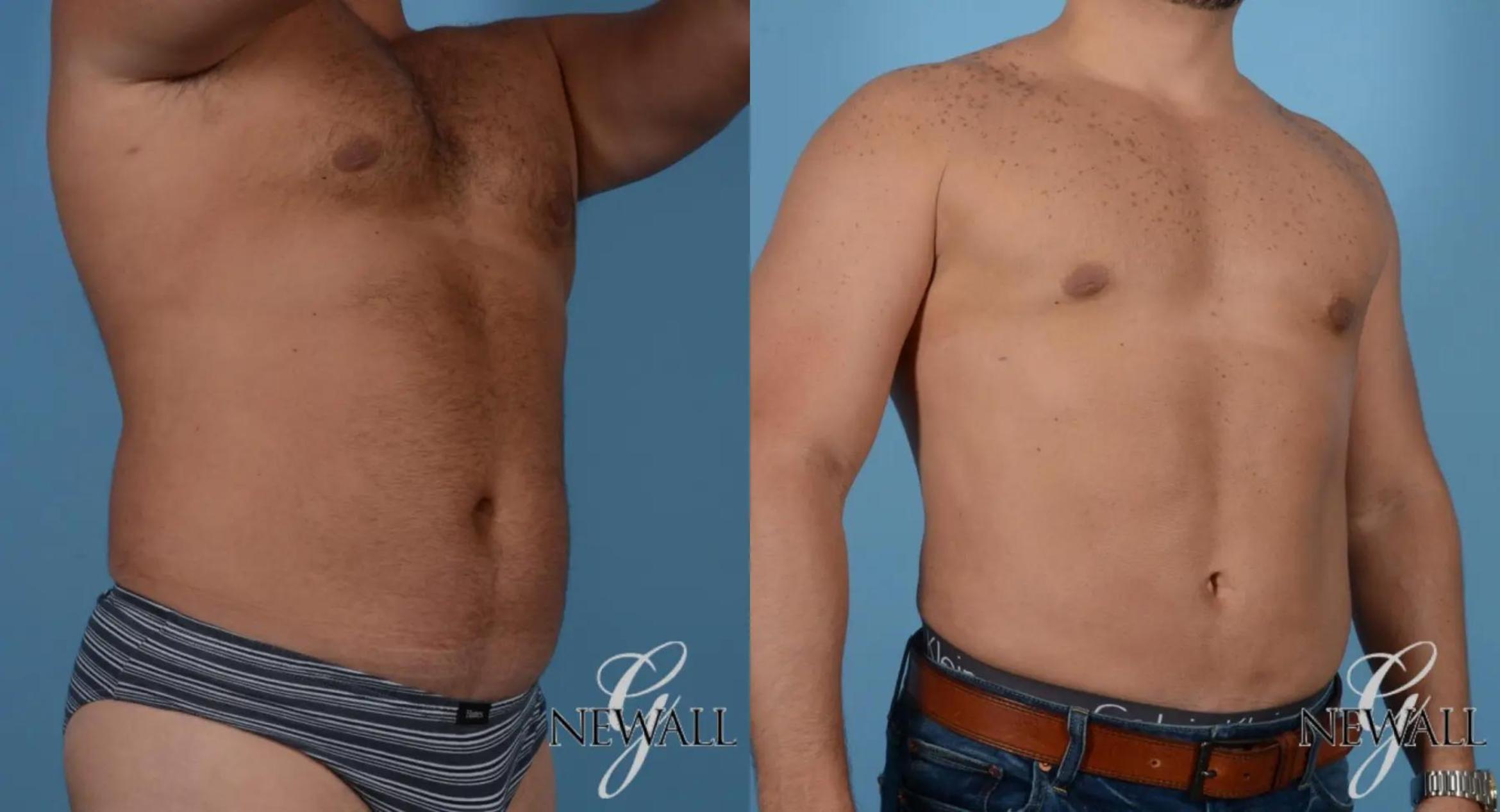 Before & After Abdominal Etching For Men Case 16978 View 2 View in Houston, TX