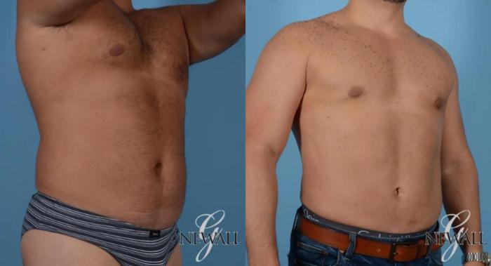 Before & After Abdominal Etching For Men Case 16978 View 2 View in Houston, TX