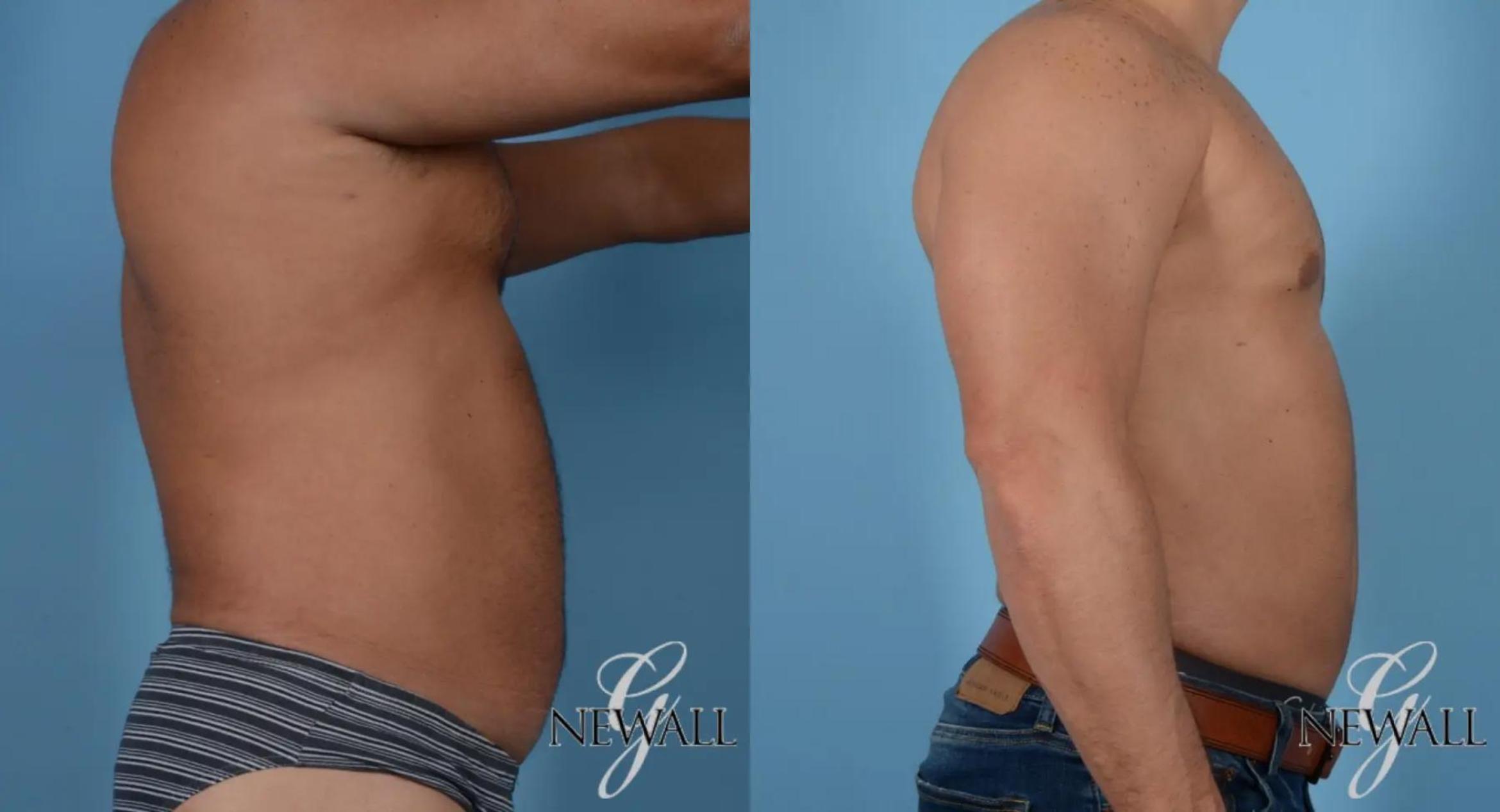 Before & After Abdominal Etching For Men Case 16978 View 3 View in Houston, TX