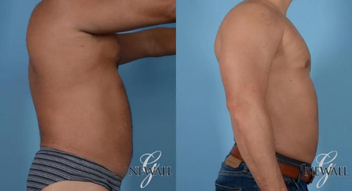 Before & After Abdominal Etching For Men Case 16978 View 3 View in Houston, TX