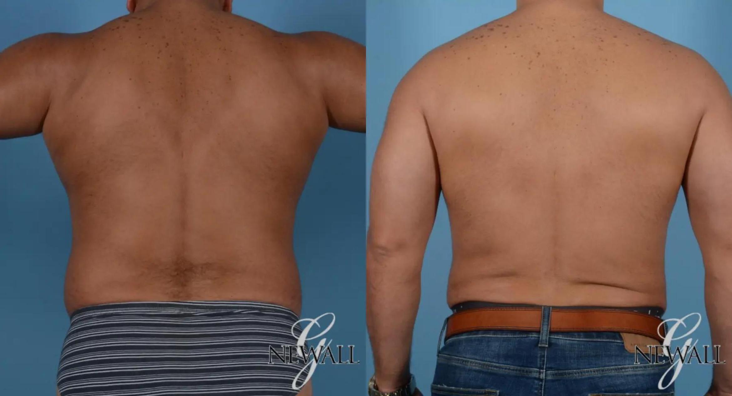 Before & After Abdominal Etching For Men Case 16978 View 4 View in Houston, TX
