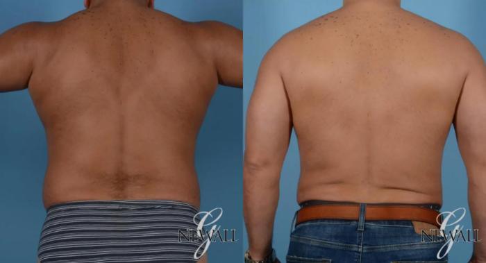 Before & After Abdominal Etching For Men Case 16978 View 4 View in Houston, TX