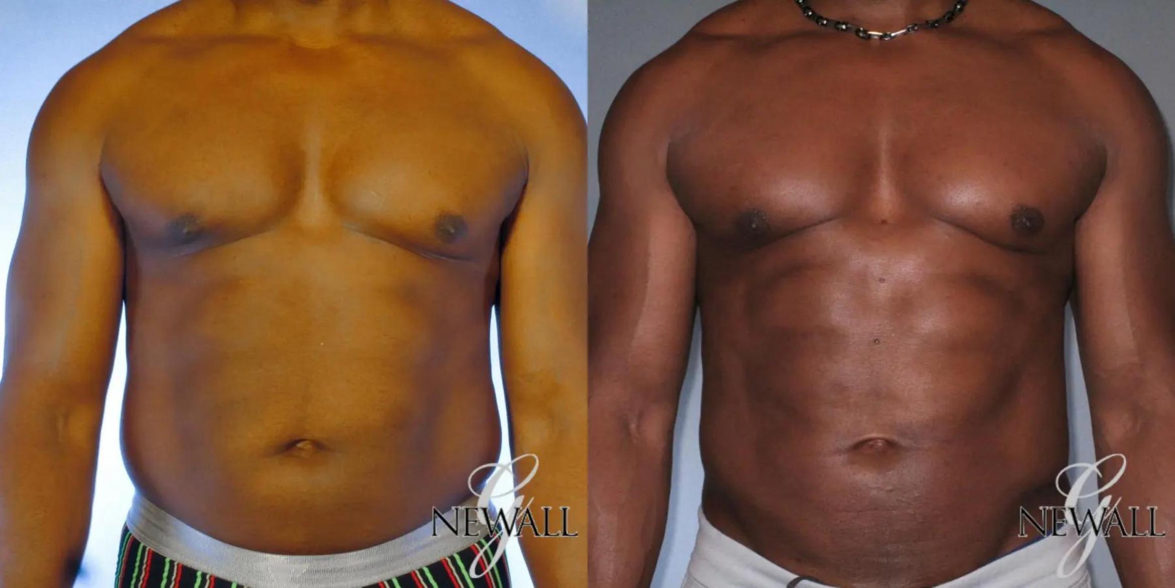 Before & After Abdominal Etching For Men Case 17043 View 1 View in Houston, TX