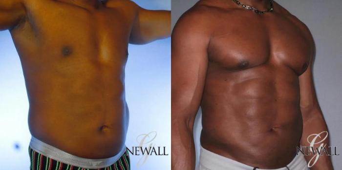 Before & After Abdominal Etching For Men Case 17043 View 2 View in Houston, TX