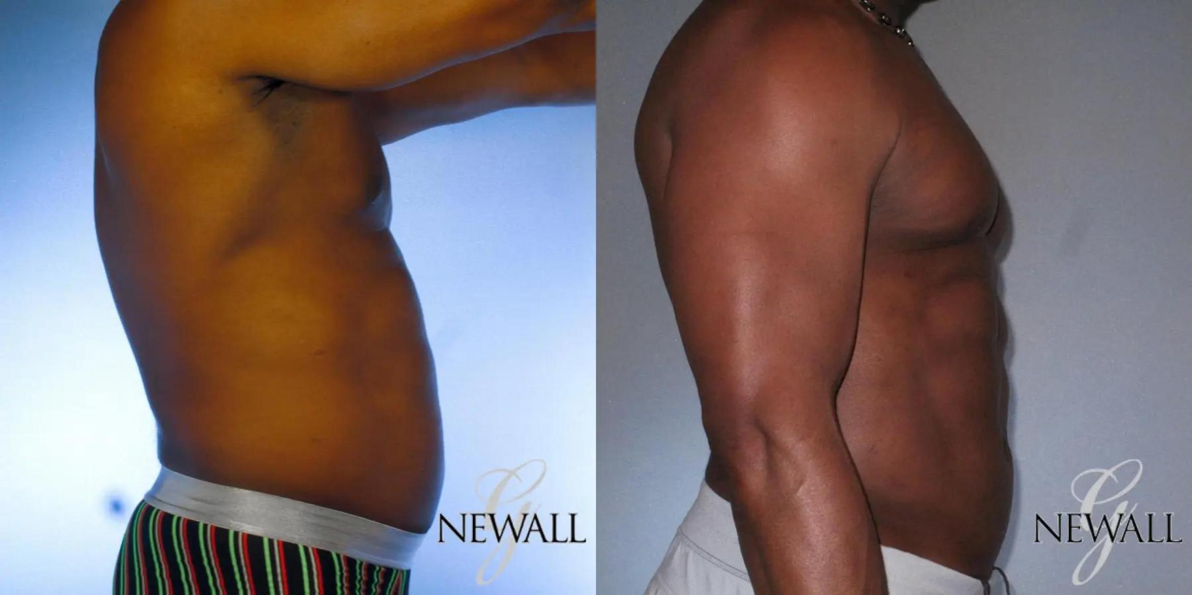 Before & After Abdominal Etching For Men Case 17043 View 3 View in Houston, TX