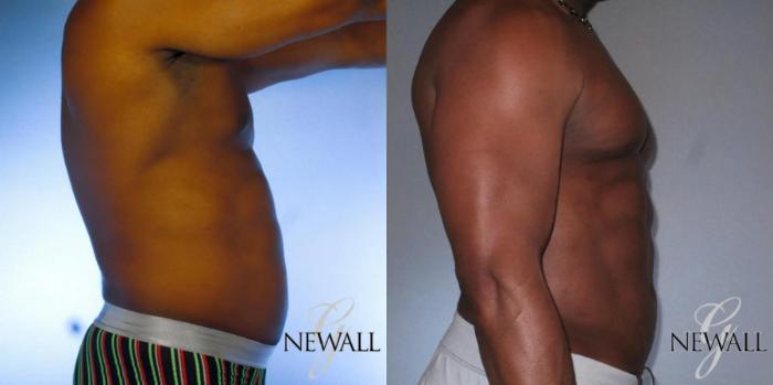 Before & After Abdominal Etching For Men Case 17043 View 3 View in Houston, TX